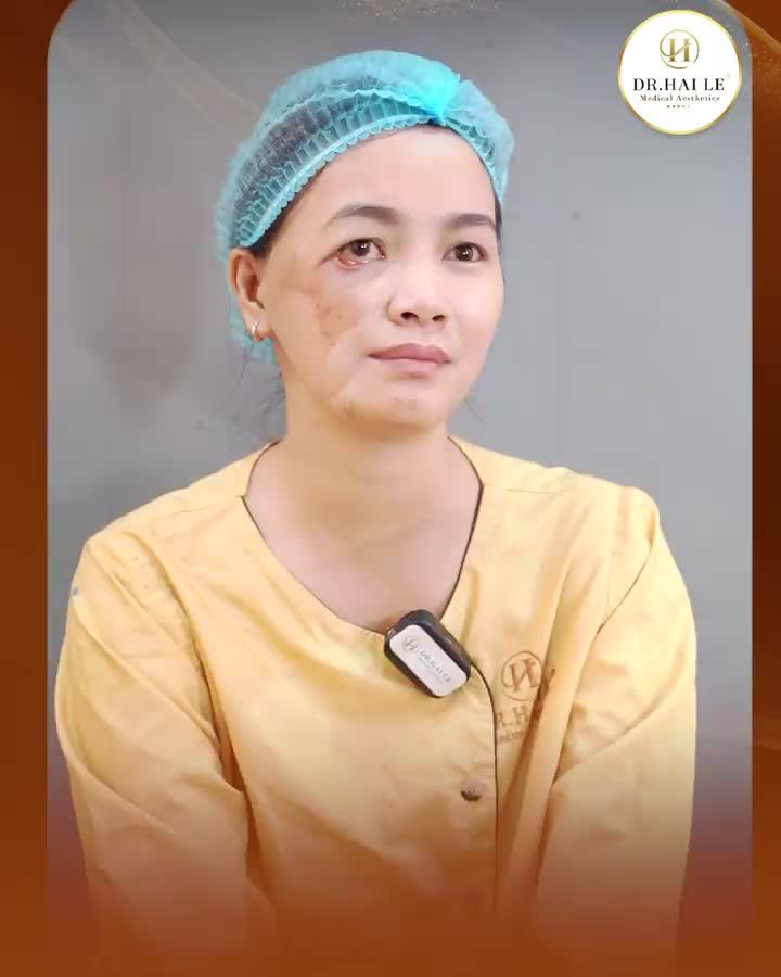 Bị bỏng than khi chỉ mới 2 tháng tuổi, những di chứng để lại trên gương mặt và đôi mắt là nỗi ám ảnh đối với chị...