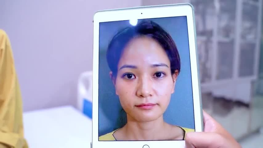 Gò má cao, thái dương hóp được khắc phục như thế nào sau khi đến Dr.Hải Lê? Theo dõi ngay