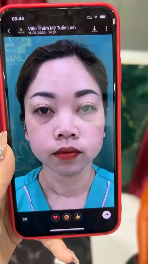 Case mũi cấu trúc được 10 ngày