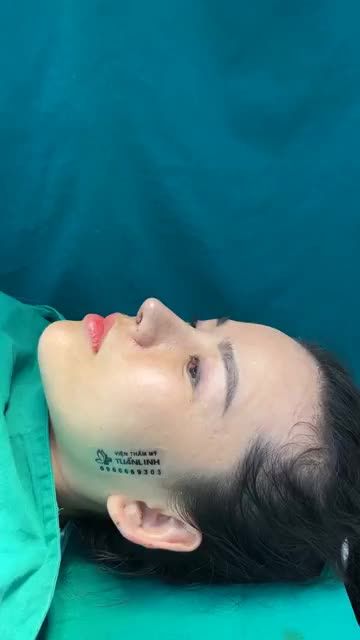 Case mũi tái cấu trúc vừa hoàn thành