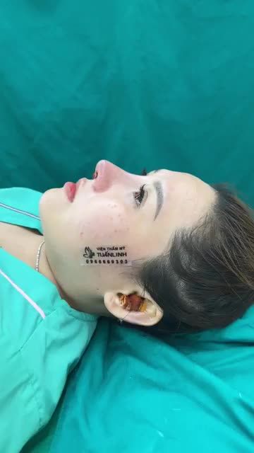 Viện thẩm mỹ Tuấn Linh vừa thực hiện xong ca  Nâng mũi cấu trúc  sửa lại cho bạn gái đã từng nâng mũi được tám tháng,  Mũi trước bị lệch và lộ sóng mũi
