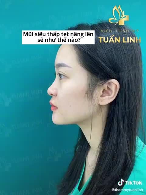 Mũi siêu thấp tẹt nâng lên sẽ thay đổi khuôn mặt bạn như thế nào??