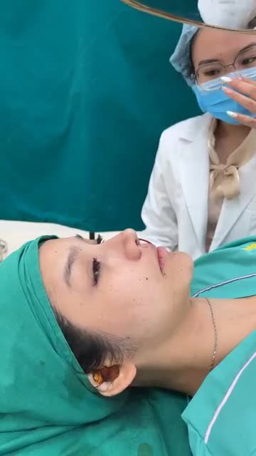 Case mũi cấu trúc vừa hoàn thành cho bạn khách đến từ singapore