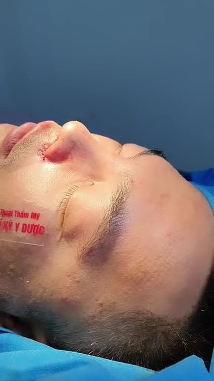 Sở hữu chiếc mũi thấp, đầu mũi hếch và lỗ mũi lộ rõ.