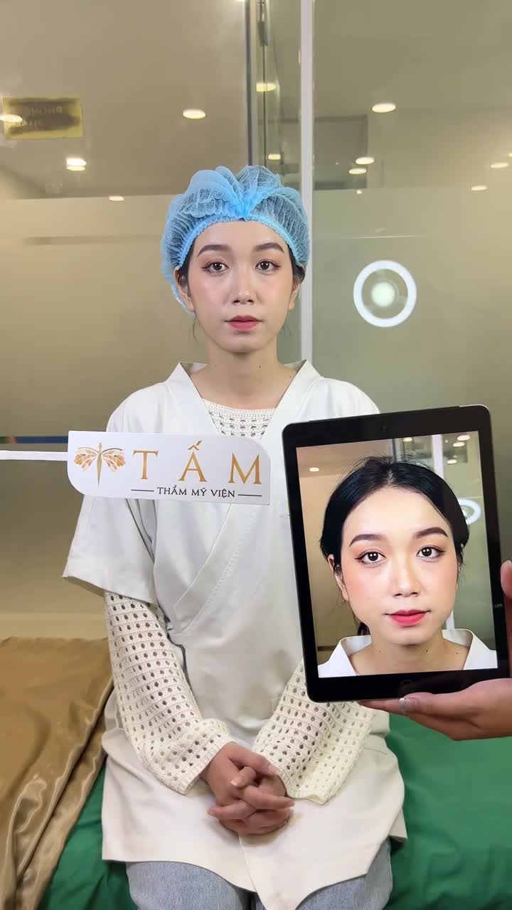Mặt lệch, kém thanh thoát và góc hàm hơi vuông nhẹ - Là tình trạng của chị Tường Vy trước khi đến với TMV Tấm