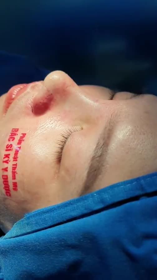 Bạn khách chọn gói nâng mũi tốt nhất là Nâng Mũi ALINE Cấu Trúc Đa Lớp để tân trang chiếc mũi của mình.