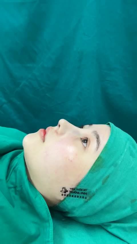Case mũi cấu trúc vừa hoàn thành