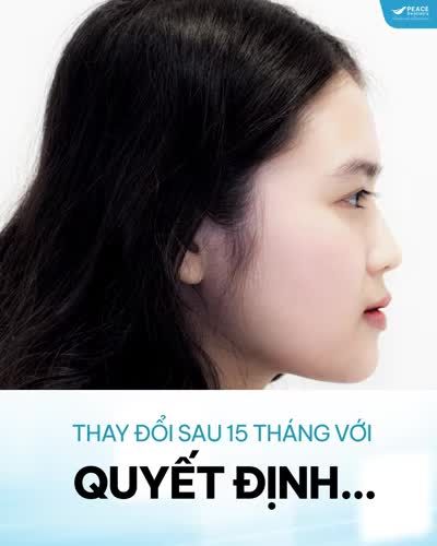 "TIẾC VÌ ĐÃ KHÔNG NIỀNG RĂNG SỚM HƠN"