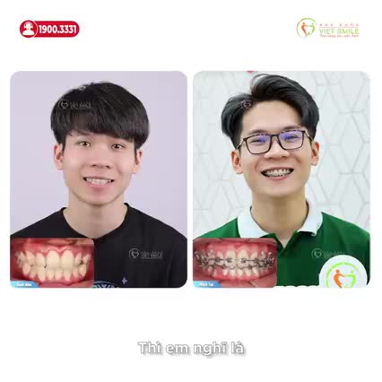 BẤT NGỜ VỚI SỰ THAY ĐỔI SAU HƠN 1 NĂM NIỀNG RĂNG TẠI VIET SMILE