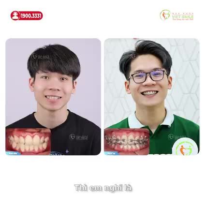 BẤT NGỜ VỚI SỰ THAY ĐỔI SAU HƠN 1 NĂM NIỀNG RĂNG TẠI VIET SMILE