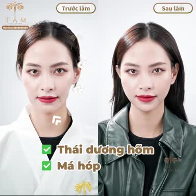 "Chỉ cần 30 phút để hoàn thiện khuyết điểm nhan sắc, sở hữu gương mặt đẹp chuẩn mực  KHÔNG ĐAU - ĐẸP NGAY SAU LÀM - KHÔNG CẦN NGHỈ DƯỠNG