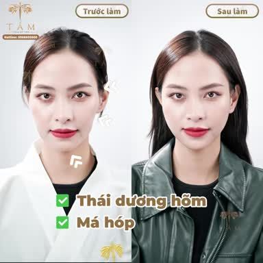 "Chỉ cần 30 phút để hoàn thiện khuyết điểm nhan sắc, sở hữu gương mặt đẹp chuẩn mực  KHÔNG ĐAU - ĐẸP NGAY SAU LÀM - KHÔNG CẦN NGHỈ DƯỠNG