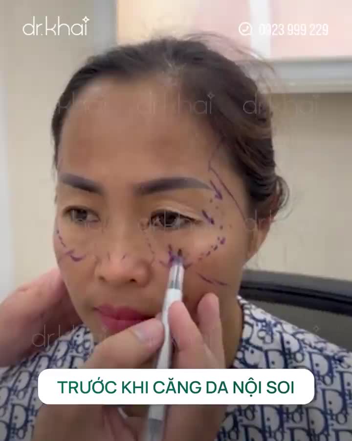 SỰ THAY ĐỔI ĐÁNG KINH NGẠC SAU KHI CĂNG DA NỘI SOI