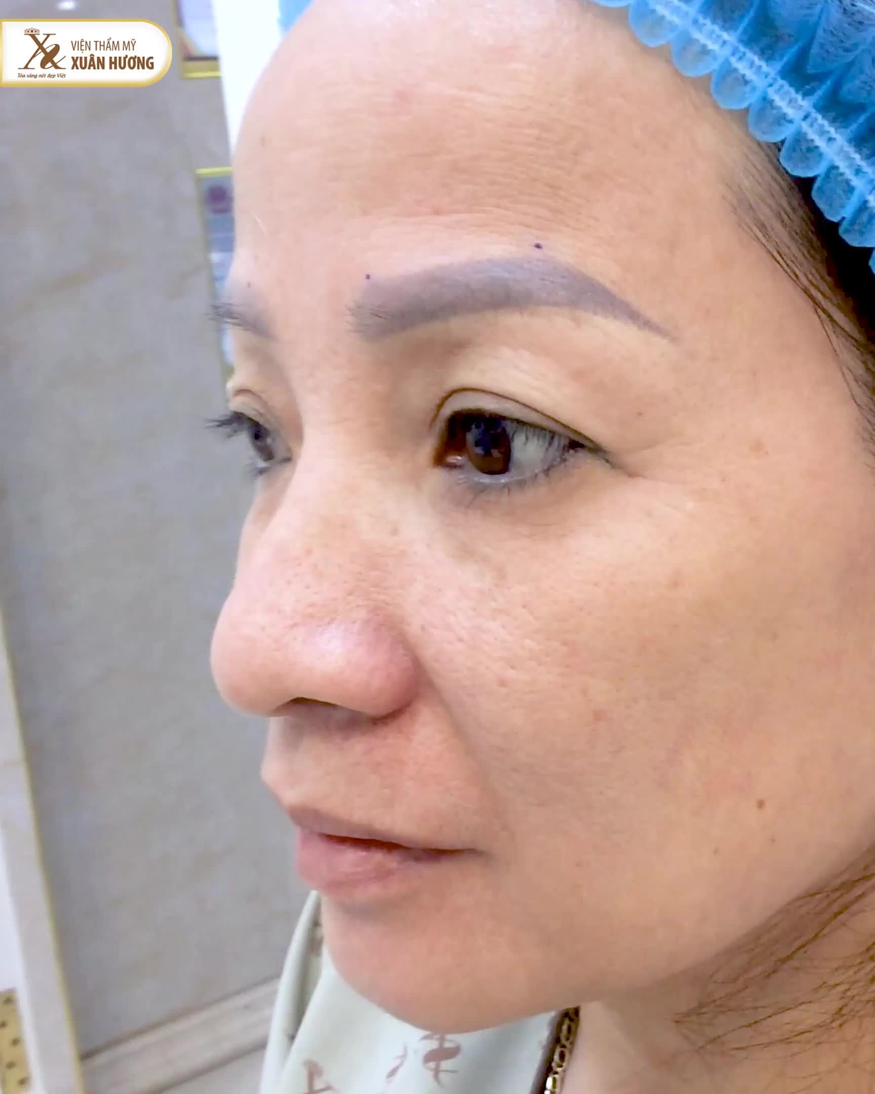 Sau 5 ngày Nâng cung mày, tới VTM Xuân Hương rút chỉ, cô khách hàng cho biết: