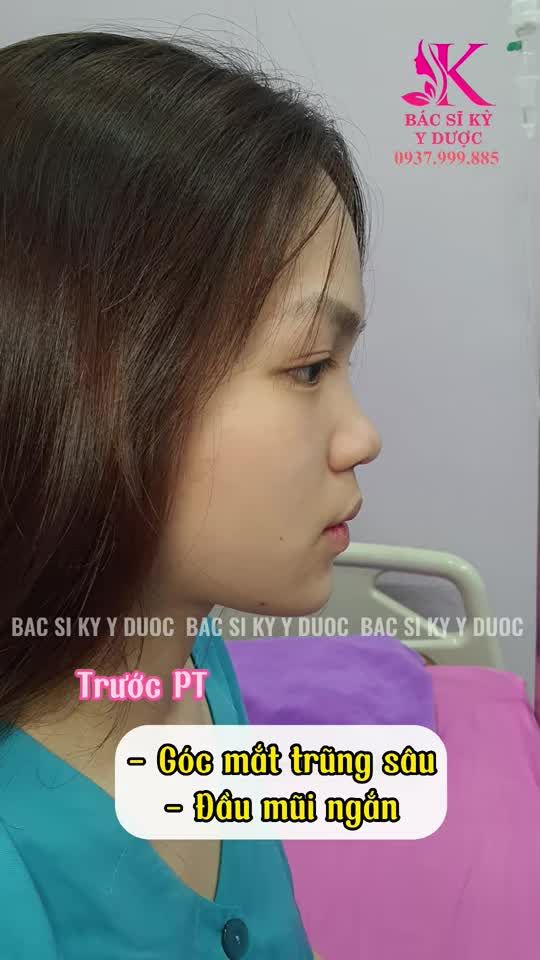 Nâng mũi có thể thay đổi bạn như thế nào?