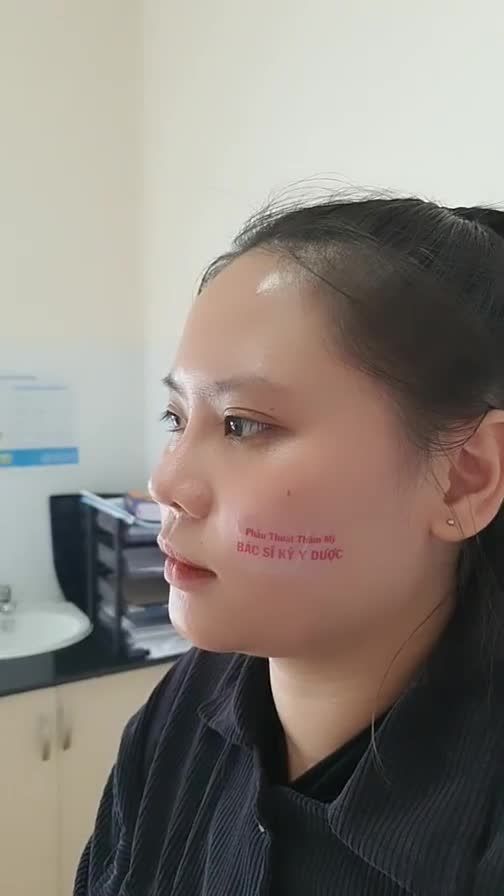 Dáng mũi ALINE sau 45 ngày quá ư là hết nước chấm