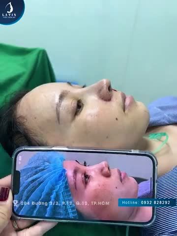 Hoàn thành ca nâng mũi cấu trúc cho khách hàng Latin
