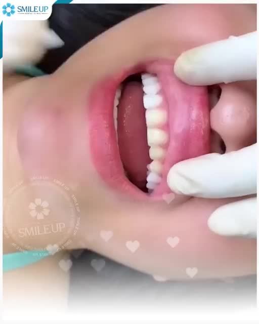 Thiết kế dáng răng hoàn mỹ chuẩn nhân tướng học, chuẩn tỉ lệ khuôn mặt, hợp độ tuổi - hợp tính cách - hợp phong thủy