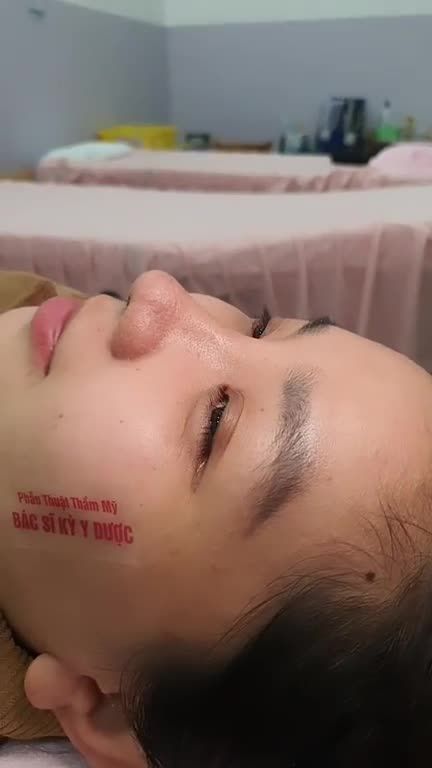 NÂNG MŨI ALINE KHÔNG ĐAU - MŨI ĐẸP SAU 11 NGÀY