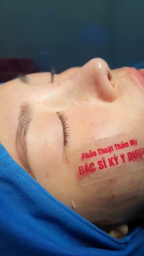 Nâng mũi Aline là phương pháp nâng mũi mới nhất, và hiện đại nhất. Dáng Aline là sự kết hợp giữa Sline và Lline.