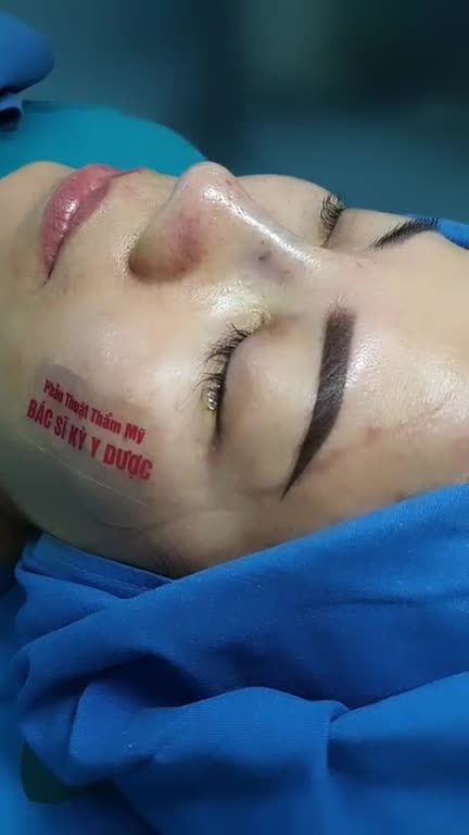 Mũi là điểm nhấn quyết định phần lớn gương mặt của Bạn. Tạo điểm nhấn thu hút người đối diện và mọi ánh nhìn.