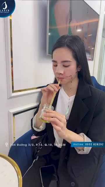 Khách hàng nói gì sau khi vừa thực hiện thành công nâng mũi tại Latin