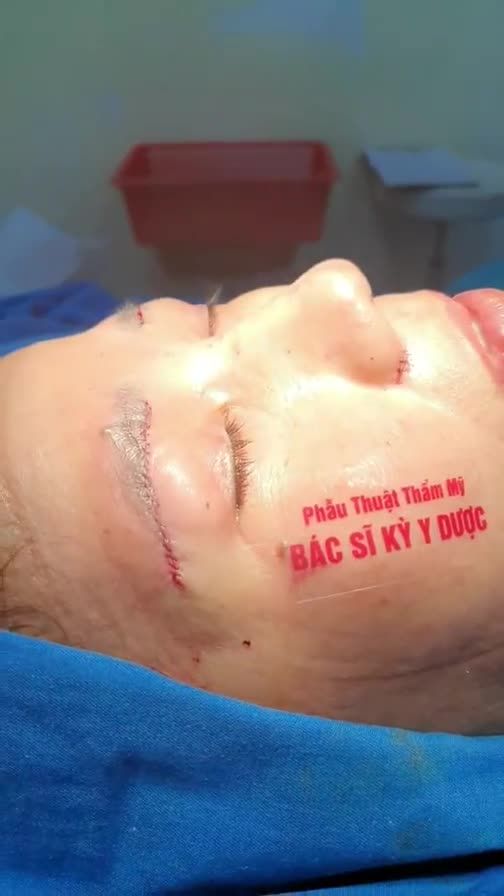 Tuổi trung niên khiến nếp mí nhăn nheo, sưng bụp và không đều nhau.