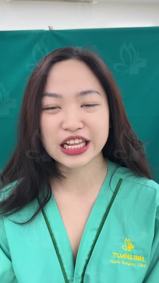 Khách hàng: Thích dáng mũi cao vừa, hài hòa tự nhiên, đầu mũi bay hợp phong thủy.
