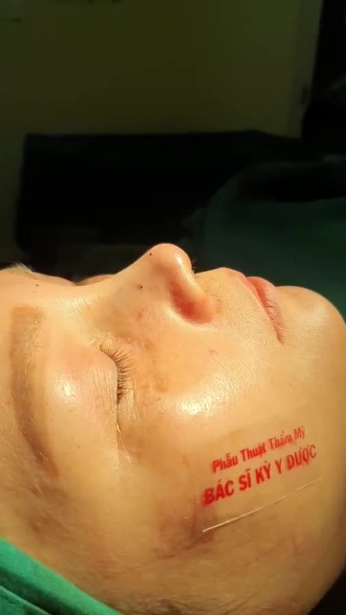 DÁNG MŨI ALINE ĐẸP NGAY SAU NÂNG