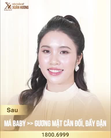 Hot Girl Mộc Trà từng rất phiền lòng với tình trạng má hóp, mặt lệch = >> Khuôn mặt già hơn tuổi
