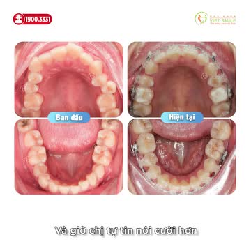 THĂM KHÁM TRỰC TIẾP, TỰ TIN CHỌN NIỀNG RĂNG MẮC CÀI PHA LÊ