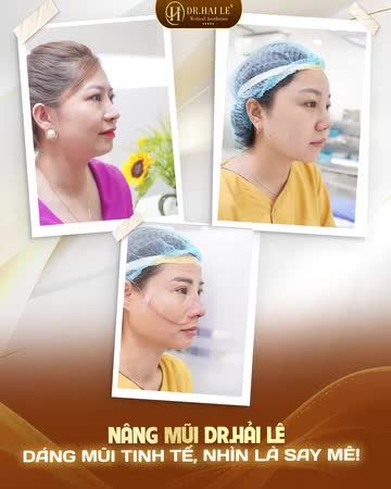 NÂNG MŨI DR.HẢI LÊ – ĐẸP SANG KHÔNG SẾN