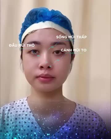TRƯỚC VÀ SAU KHI NÂNG MŨI, NHỚ NHỮNG ĐIỀU NÀY NHÉ
