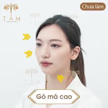 Bạn Phương Anh - KH Filler tại Tấm đã có sự thay đổi ngoạn mục chỉ sau 30 phút.