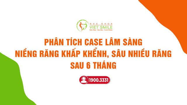 NIỀNG RĂNG TẠI VIET SMILE THAY ĐỔI RA SAO SAU 6 THÁNG?