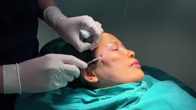 Sợi chỉ bác sĩ Lê Hữu Điền sử dụng CĂNG CHỈ TOÀN MẶT có tác dụng gì nhỉ???