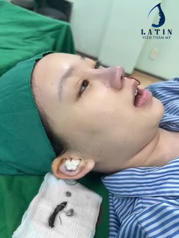 KHẮC PHỤC THÀNH CÔNG HẬU QUẢ NÂNG MŨI CHỈ