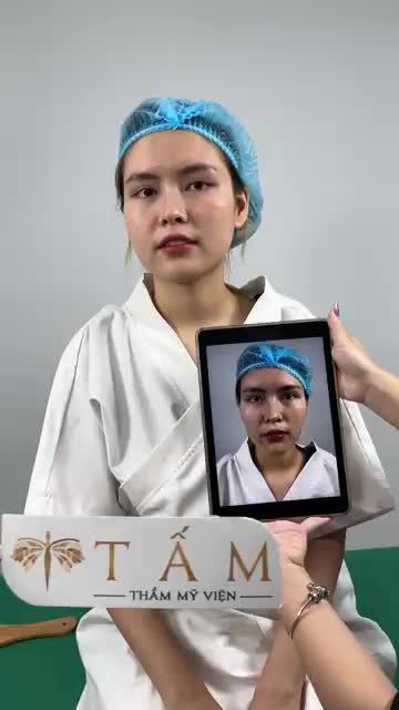 “Nhìn em như trẻ ra vài tuổi ấy” là chia sẻ của bạn Ly sau khi thực hiện xong dịch vụ filler thái dương, má tại Tấm.