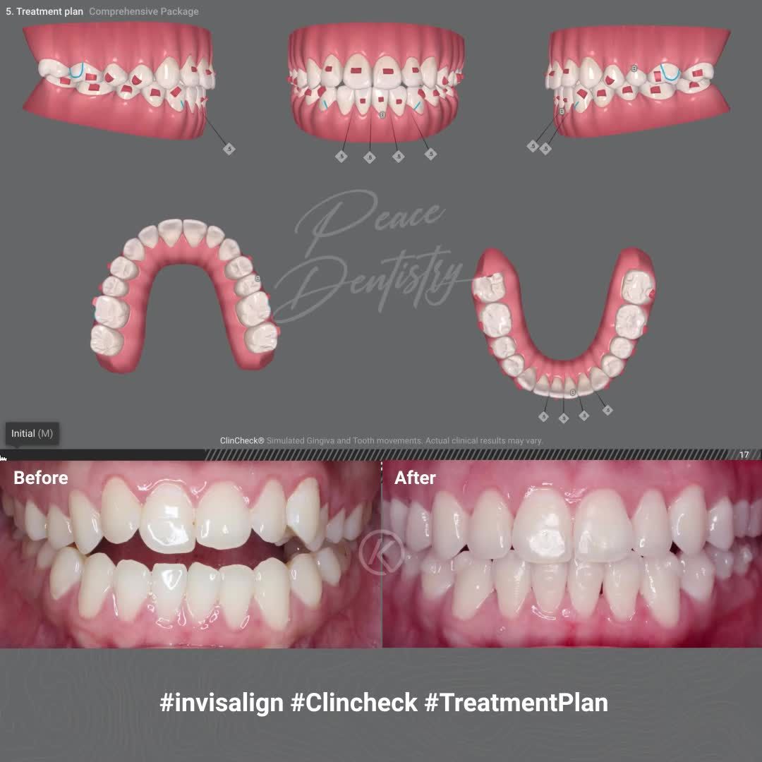 CLINCHECK - KẾ HOẠCH ĐIỀU TRỊ 3D TRONG CHỈNH NHA INVISALIGN