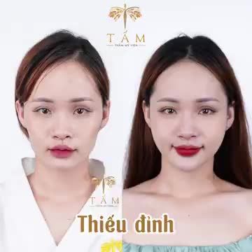 “Trước mặt má em hóp lắm, cằm ngắn nữa nên làm gì cũng không được tự tin ý. Làm xong combo má, cằm bên Tấm em ưng quá, kiểu tự nhiên, hợp mặt không bị lố” là chia sẻ của bạn Ngọc sau khi trải nghiệm dịch vụ filler bên Tấm.
