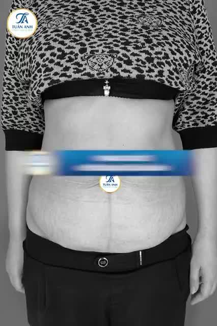 2 Lần sinh mổ - 1 Lần sinh thường Chị gái "lãi" luôn vòng eo con kiến