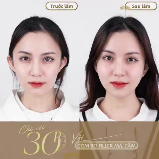 Không cần phải phẫu thuật đau đớn bạn vẫn có thể sở hữu gương mặt hoàn hảo bằng phương pháp FILLER đỉnh cao tại Tấm.