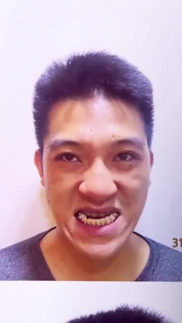 Chàng trai TUỔI HỢI CẮT XƯƠNG HÀM TRÊN, LÙI HÀM DƯỚI đổi đời sau 1 giấc ngủ tại JW