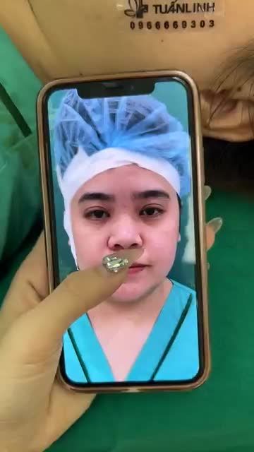 Case mũi bọc sụn cho bạn gái thích tự nhiên