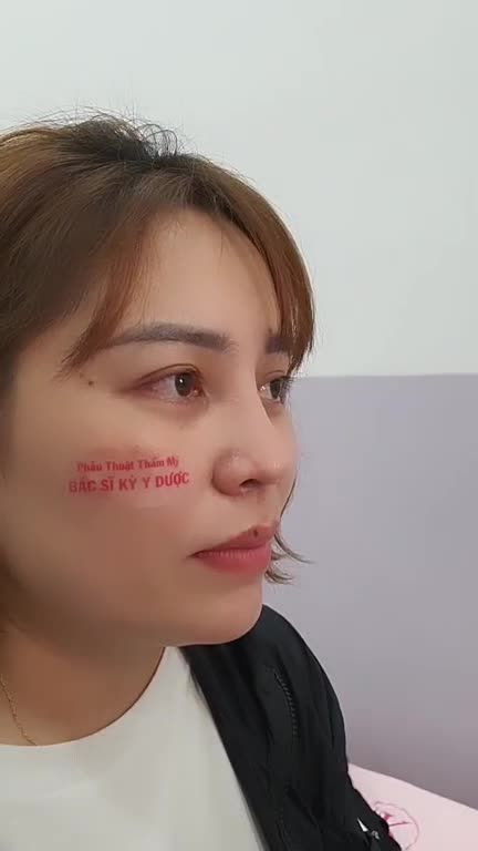 Nâng Mũi ALINE Sụn Tai 2 lớp sau 3 tháng