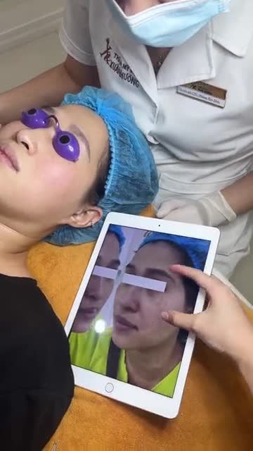 Trị nám buổi 3 với công nghệ Melas picosure Hiệu quả rõ rệt sau 2 buổi điều trị
