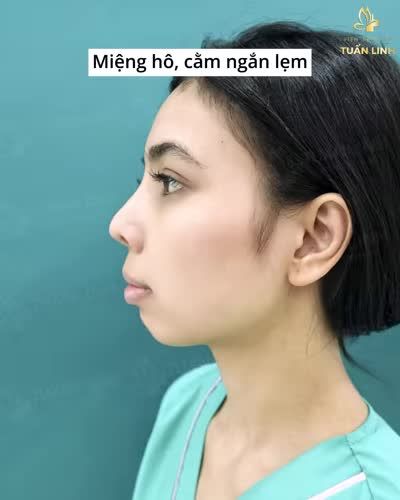 Độn cằm đã thay đổi gương mặt bạn như thế nào