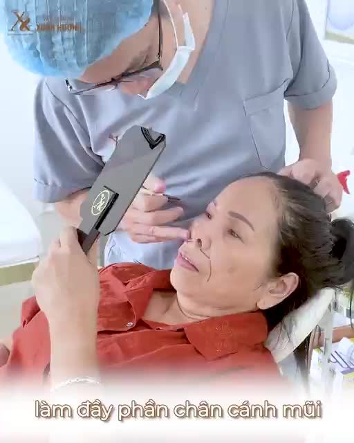 Đưa dưỡng chất làm đầy vùng mũi miệng má - Giải pháp đánh bay vết tích thời gian