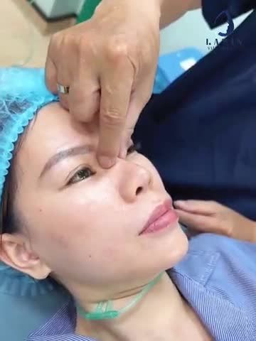 Phương pháp nâng mũi cho mũi đã từng nâng không thành công