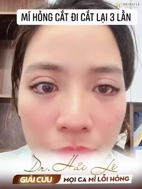 Dr.Hải Lê giải cứu mọi ca mí lỗi hỏng từ nặng đến rất nặng! Cả nhà cùng theo dõi hành trình tại đây!